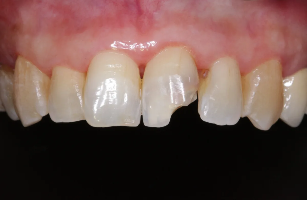 Front Teeth Restoration