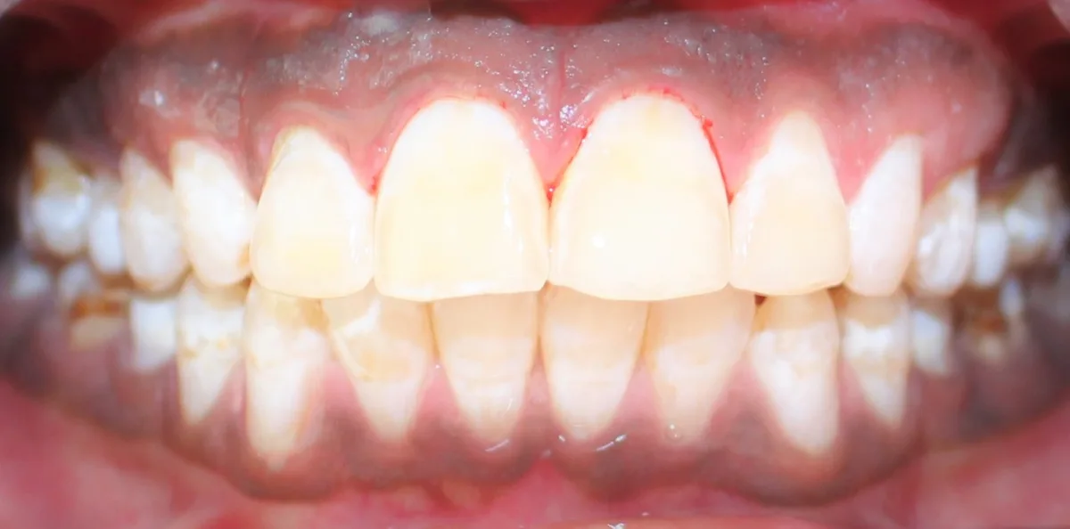 After — Teeth Whitening