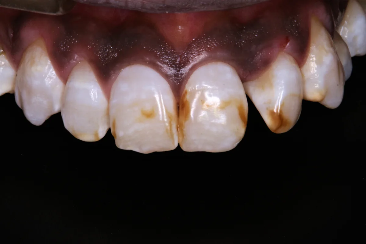 Teeth Whitening