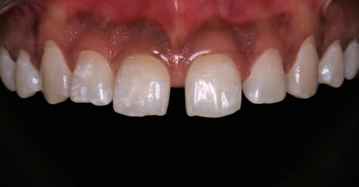 Tooth Size & Shape