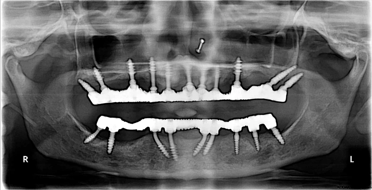 After — Basal Implants — Immediate Loading