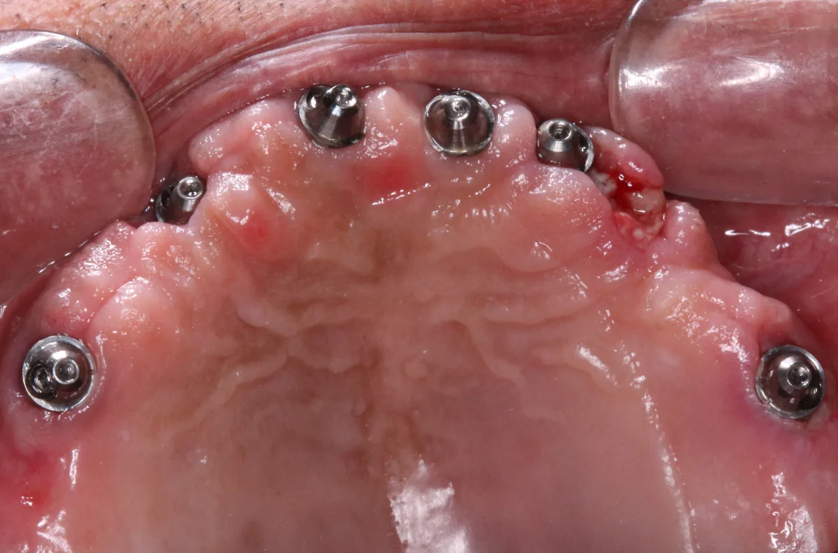Full Arch Implant Prosthesis