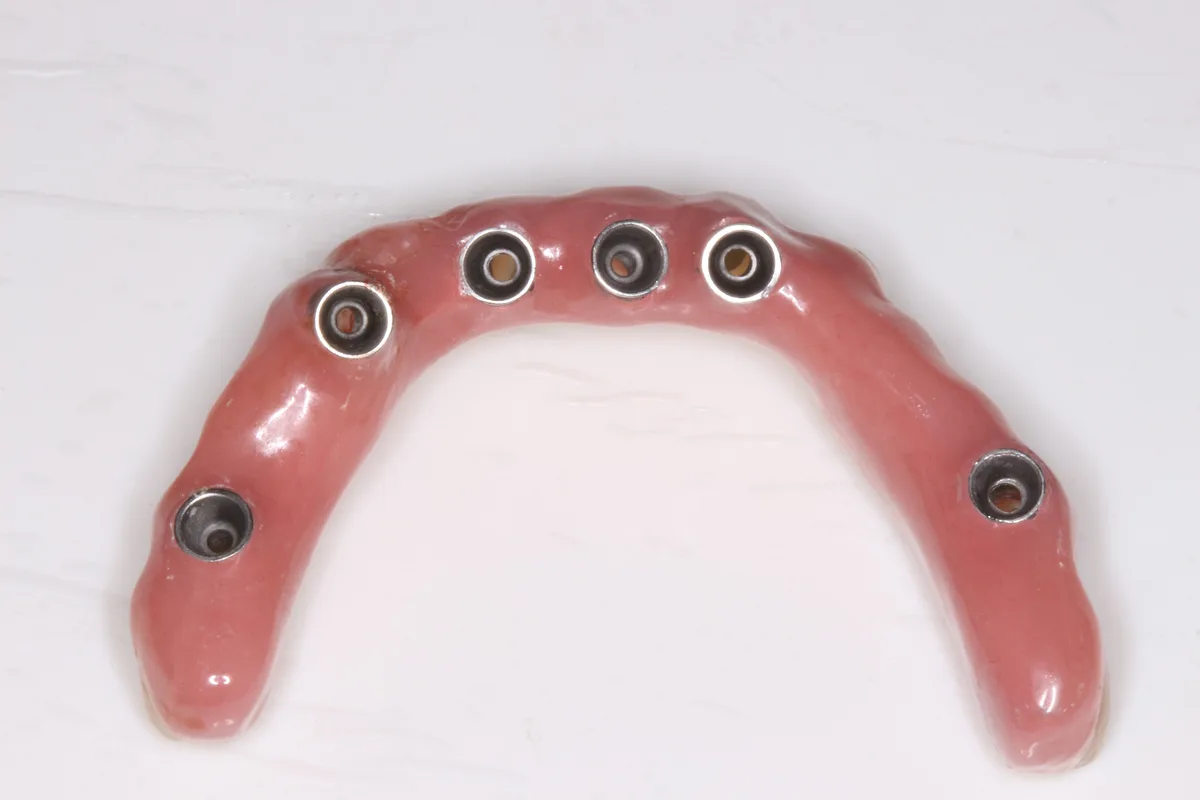 After — Full Arch Implant Prosthesis