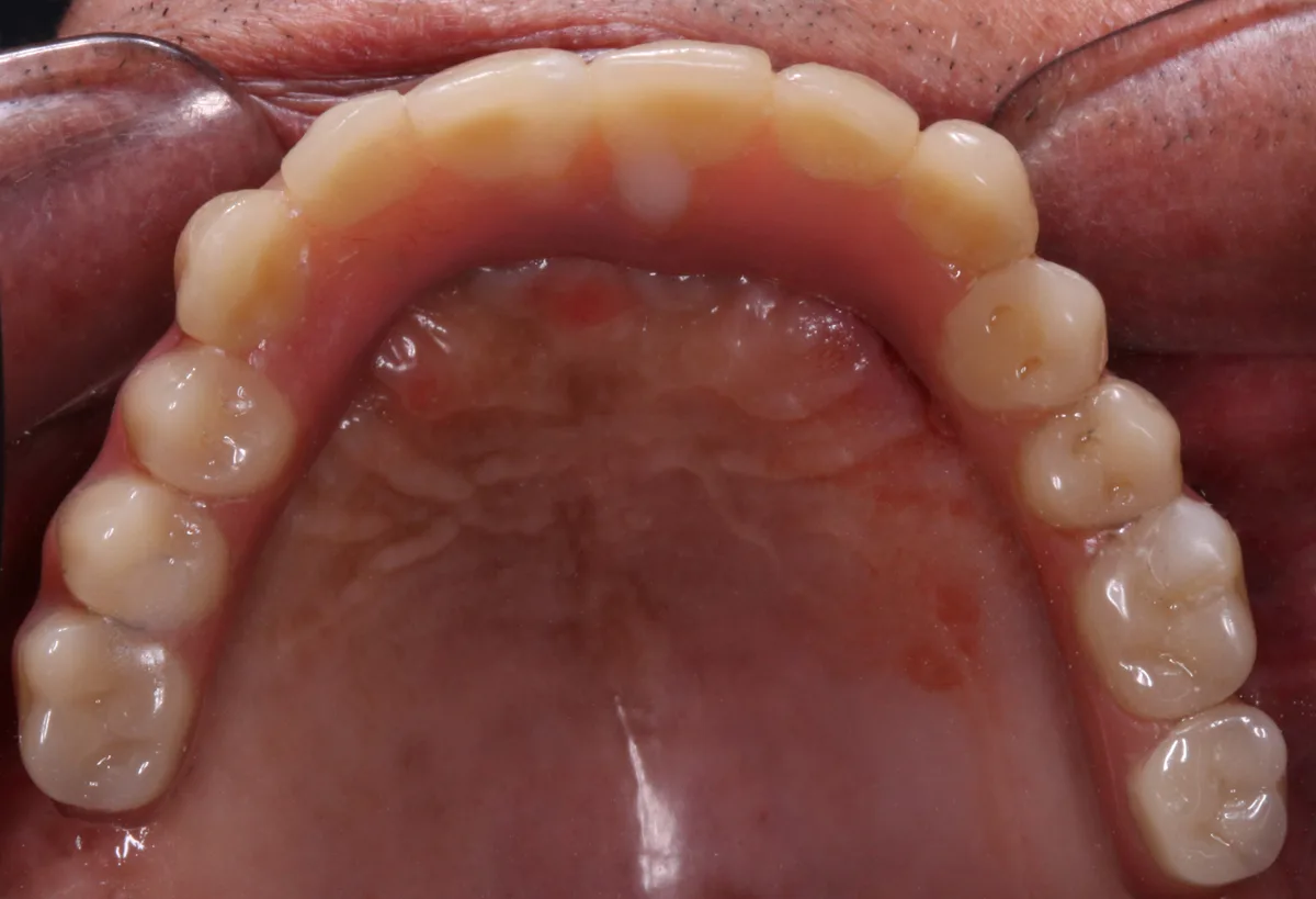 Full Arch Implant Prosthesis