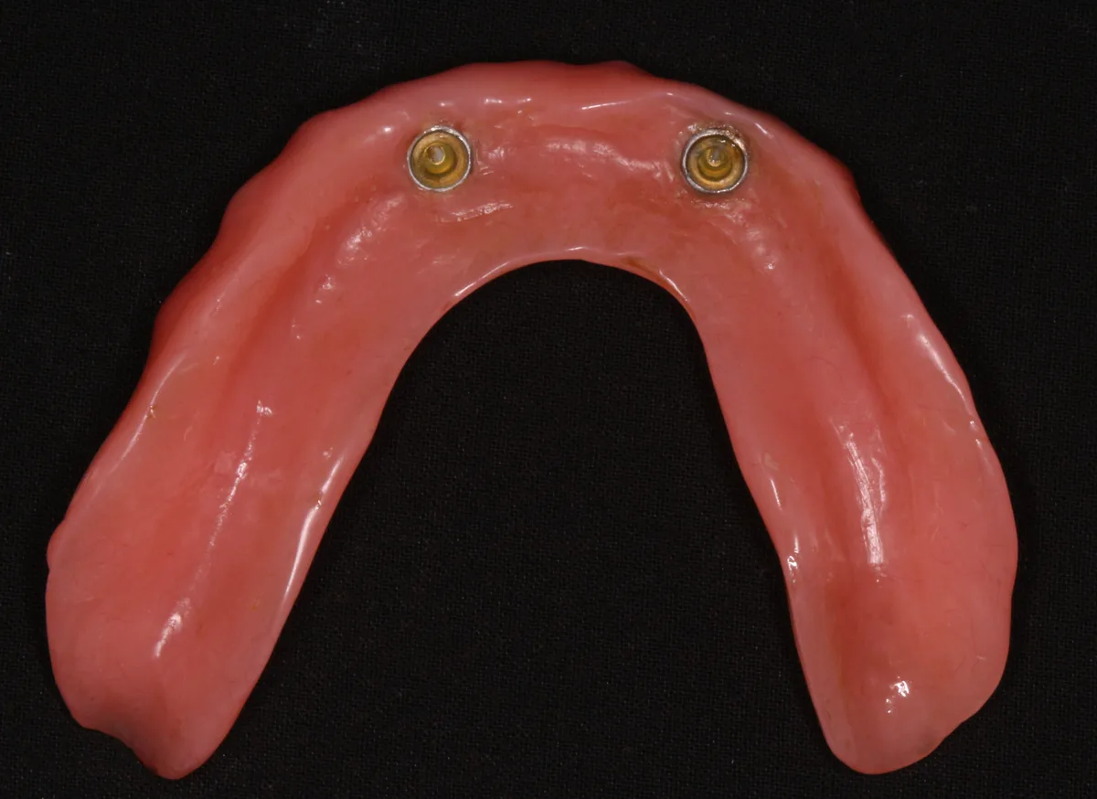 After — Implant Overdenture