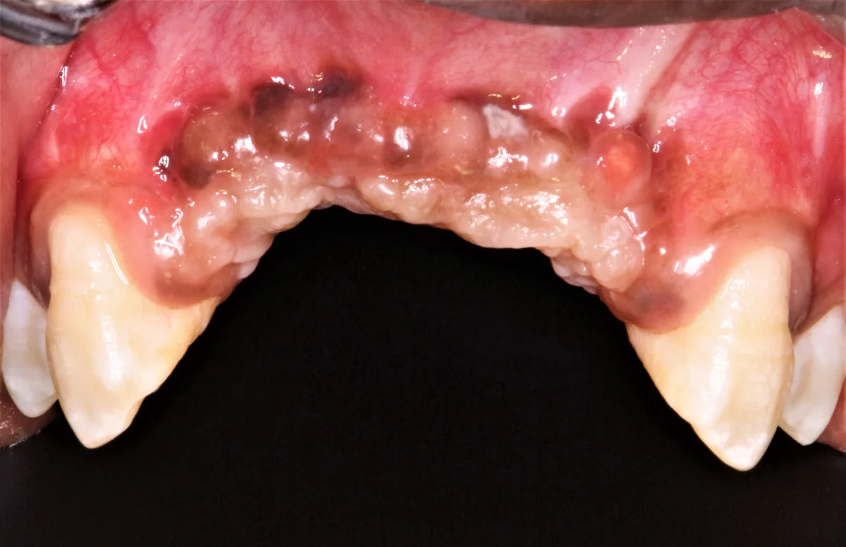 Multiple Tooth Implants