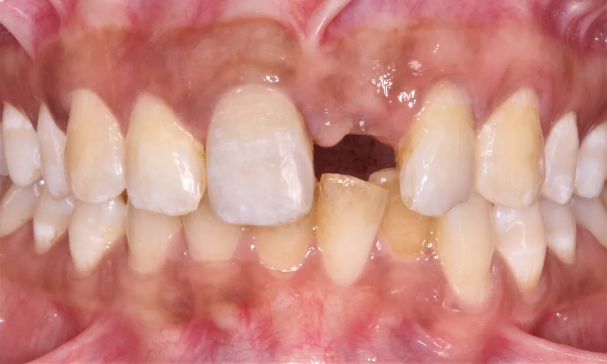 Single Tooth Implant