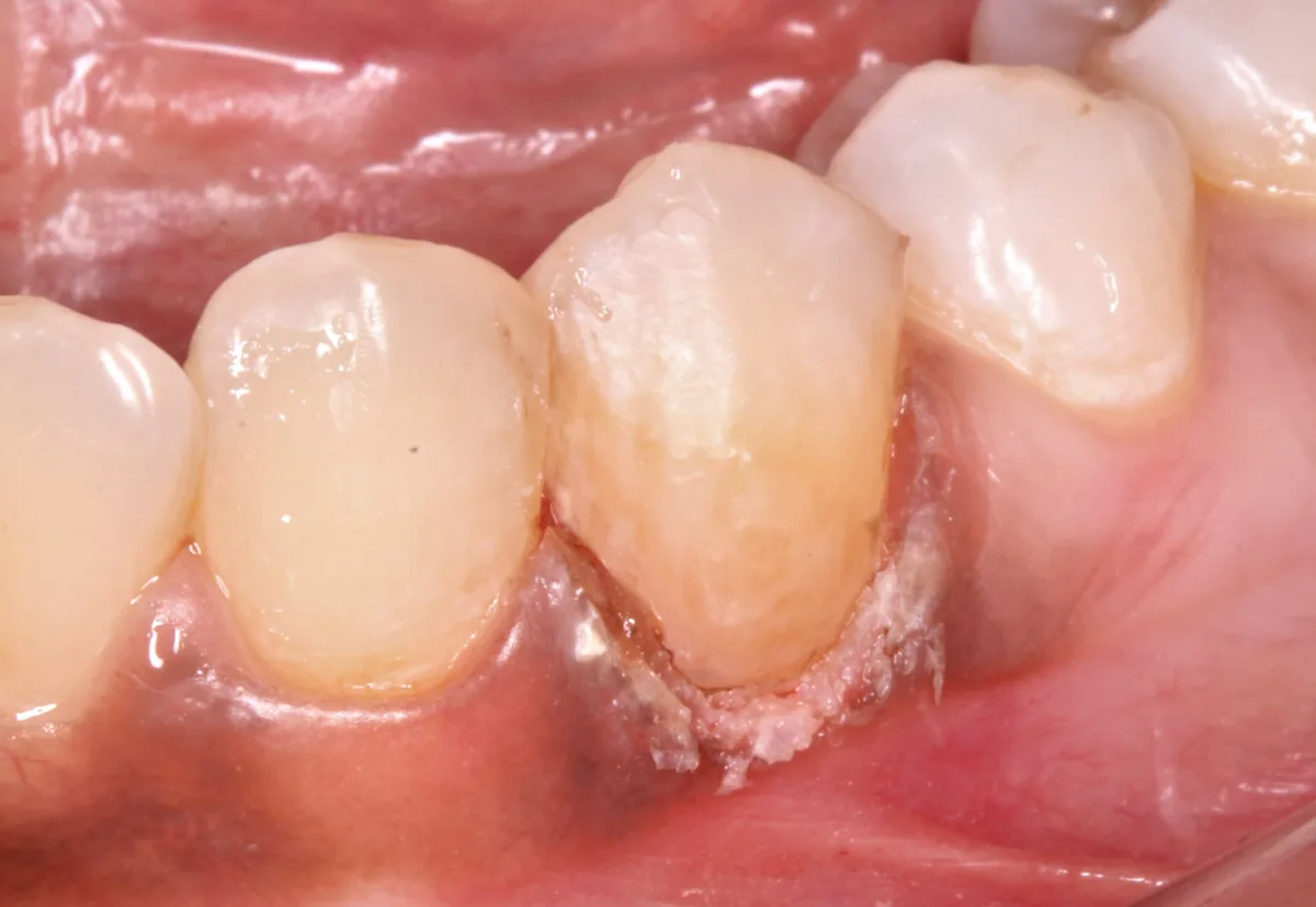 After — Gingival Shaping for Filling