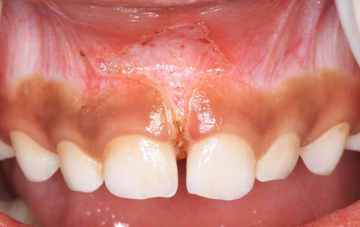 After — Laser Frenectomy