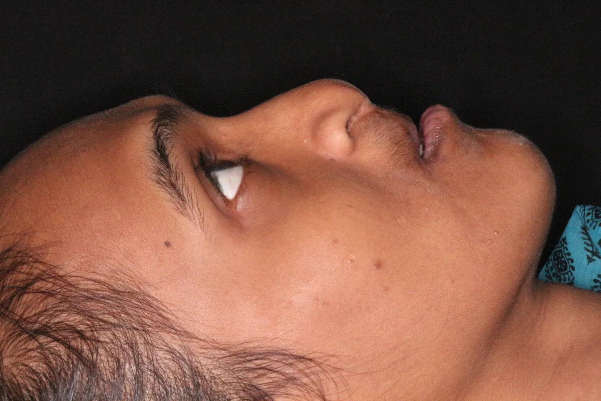 Cleft Lip & Palate Correction