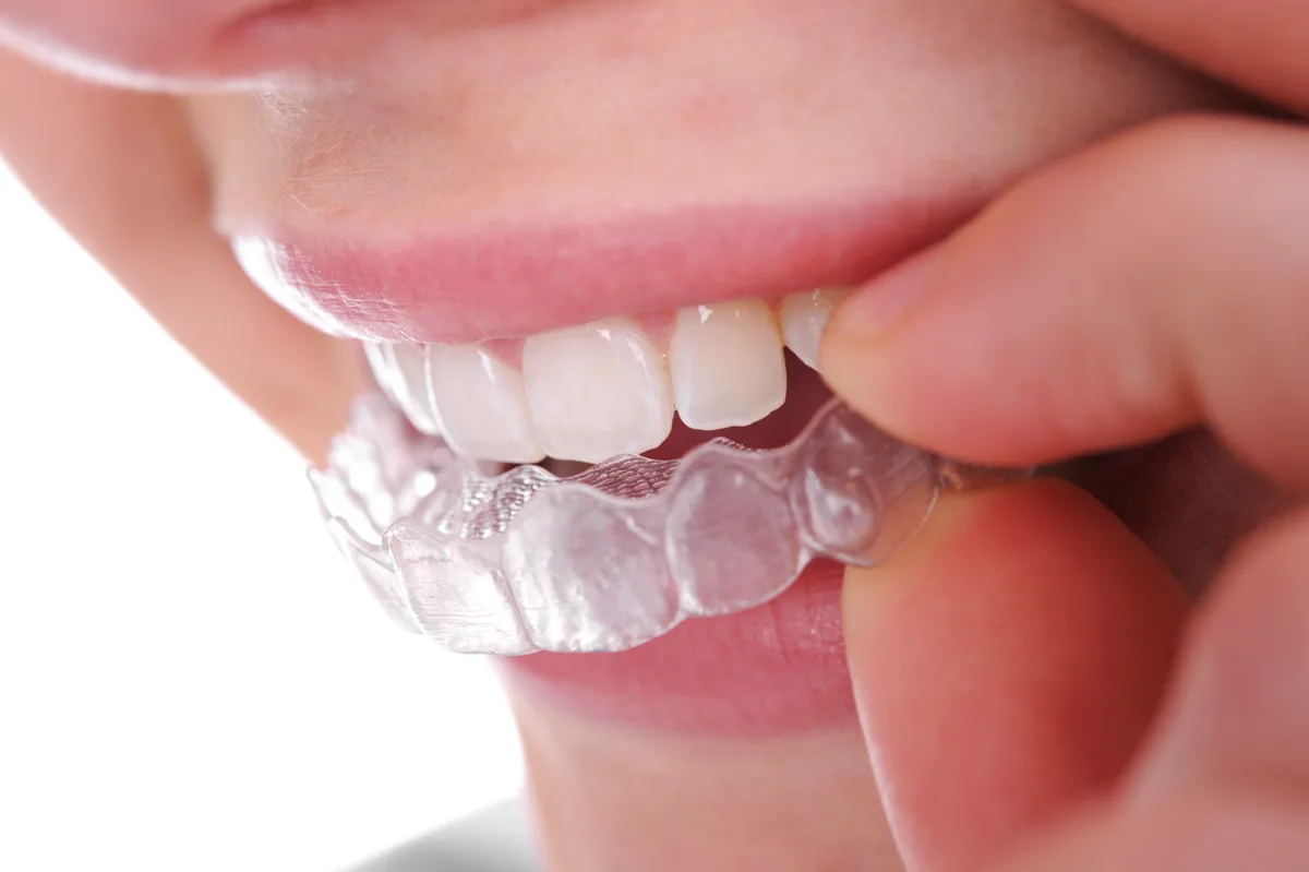 Invisible Braces (Clear Aligners)