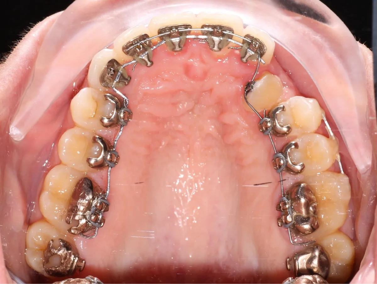 Lingual Braces