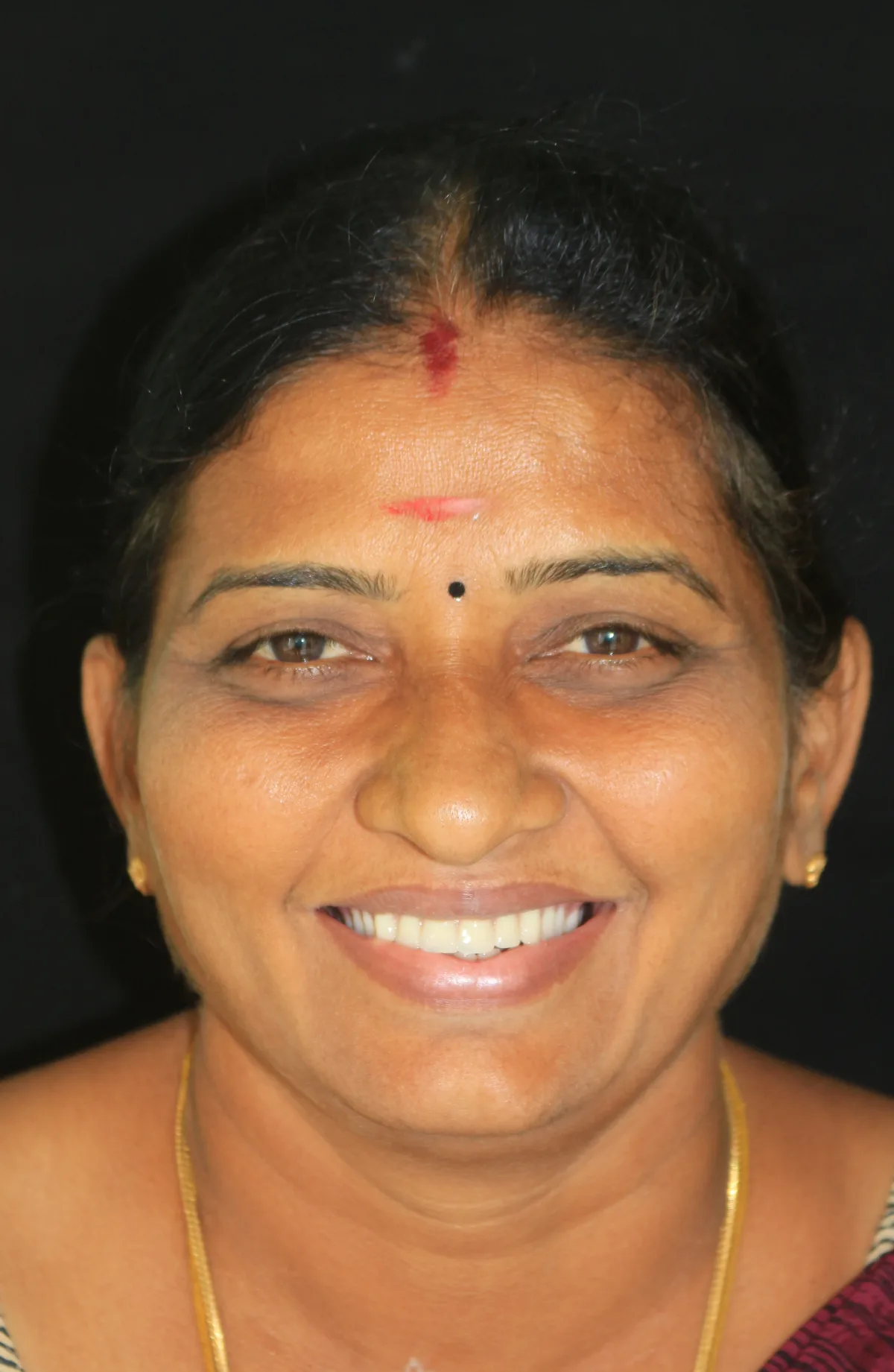 After — BPS Precision Dentures