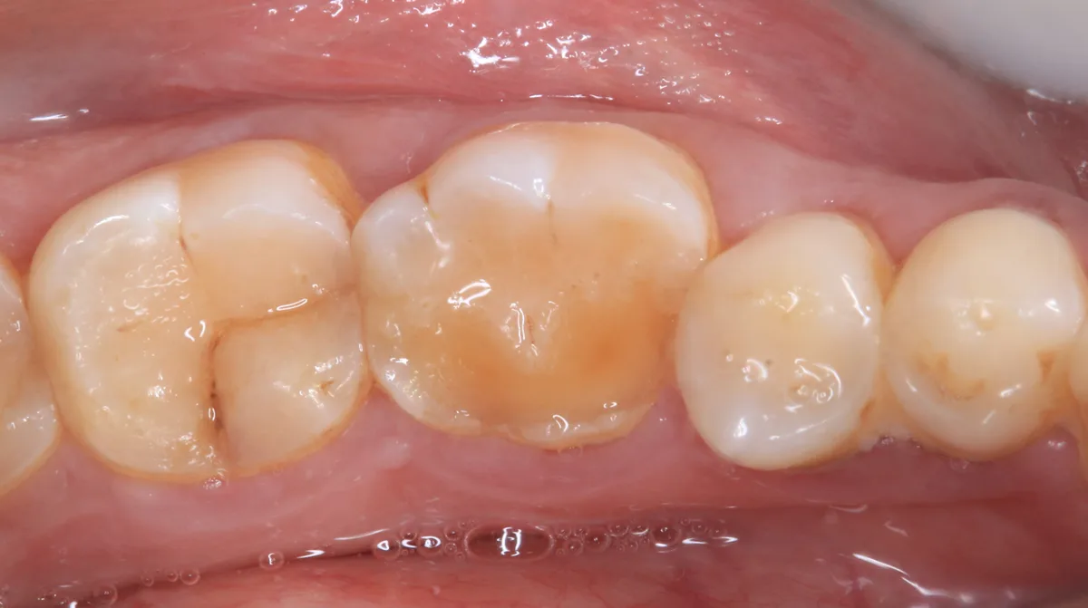 CAD/CAM Zirconia Crowns