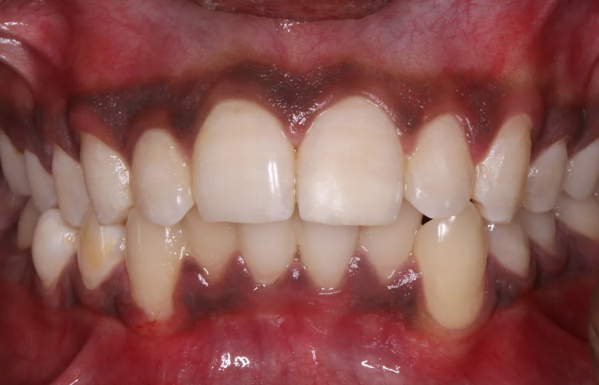 After — Fractured Tooth Management