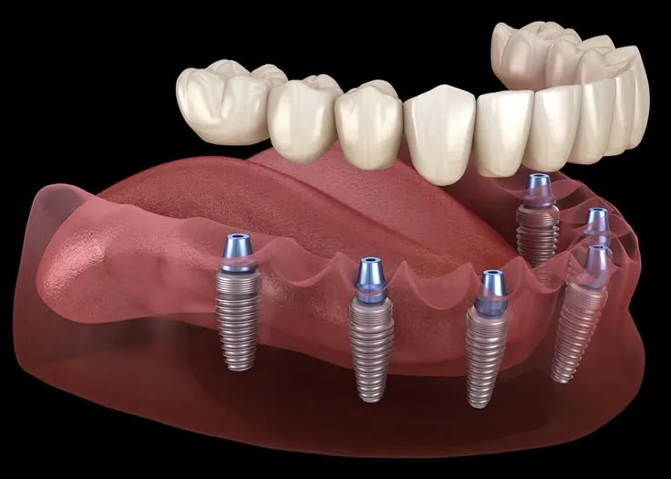 Implant Dentistry